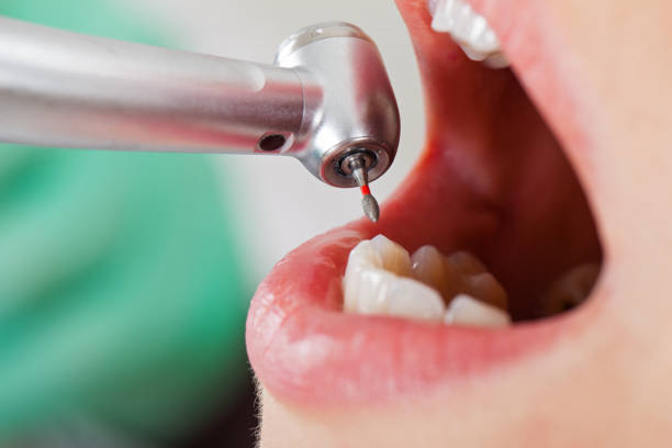 Best Emergency Wisdom Teeth Removal in Mountain City, TN